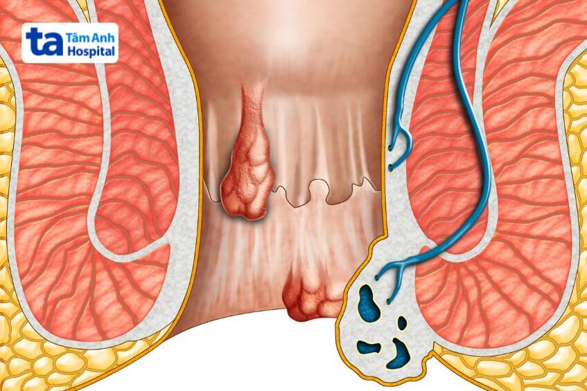 búi trĩ co lại được không