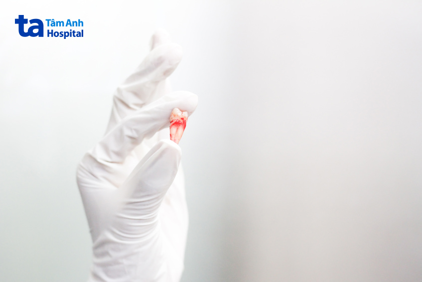 Tại sao chảy máu nhiều sau khi nhổ răng?