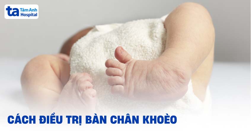4 cách điều trị bàn chân khoèo trẻ sơ sinh, bẩm sinh đúng chuẩn