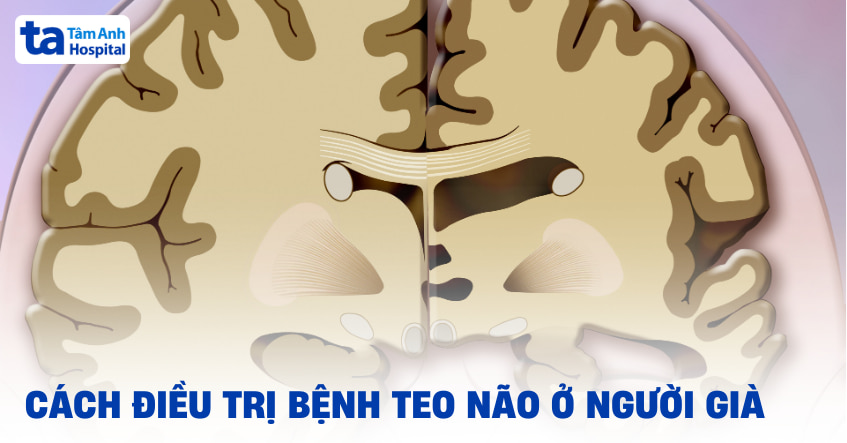 Cách điều trị bệnh teo não ở người già giúp giảm diễn tiến hiệu quả
