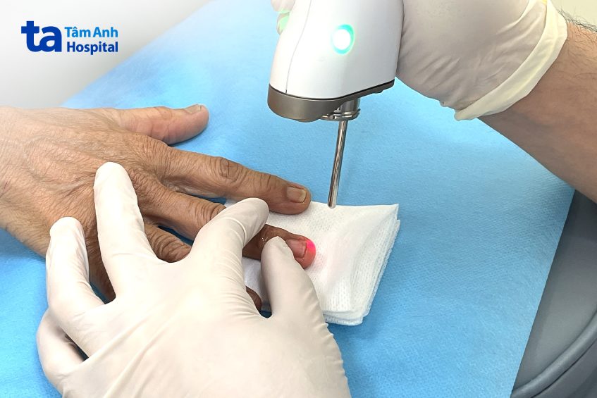 cận cảnh điều trị nấm móng tại bệnh viện