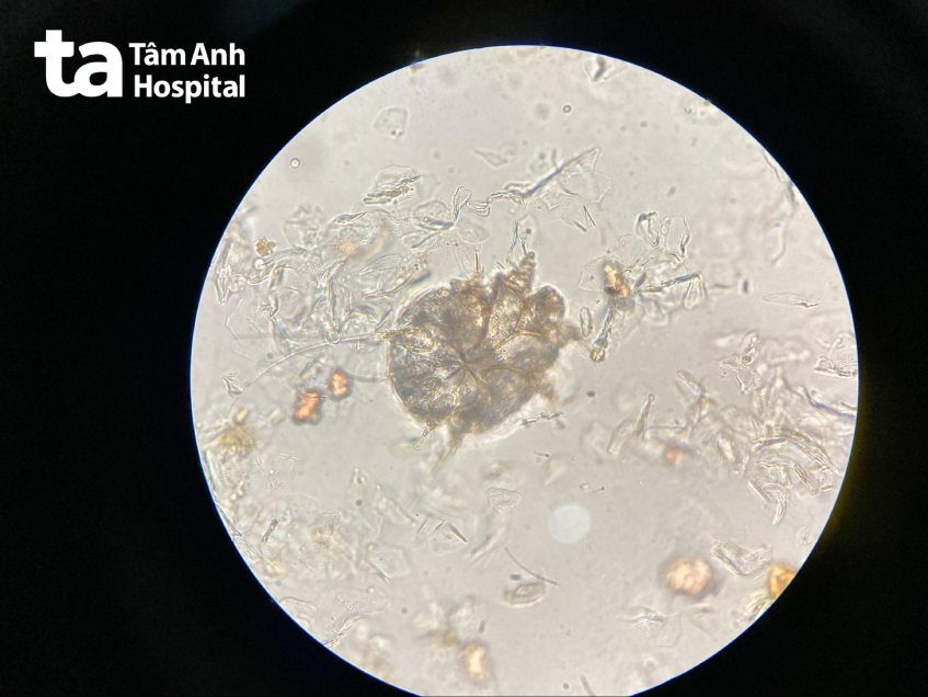 chẩn đoán bệnh ghẻ