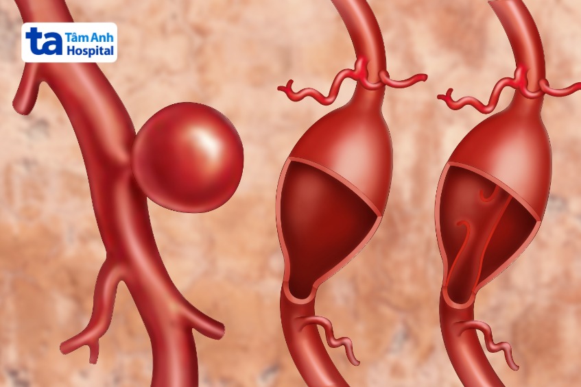 chảy máu não tái phát biến chứng xuất huyết dưới nhện