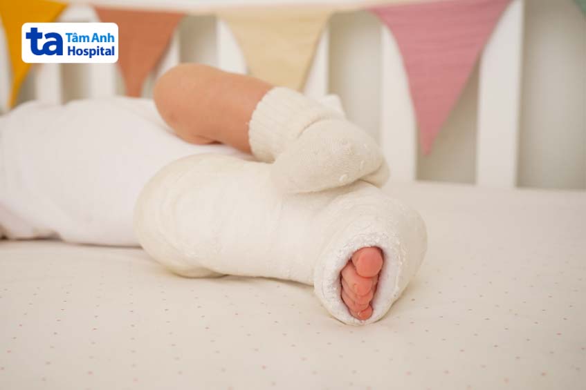 Chỉ định phương pháp điều trị bàn chân khoèo