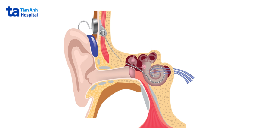 chữa bệnh điếc tai, Cấy ghép ốc tai điện tử