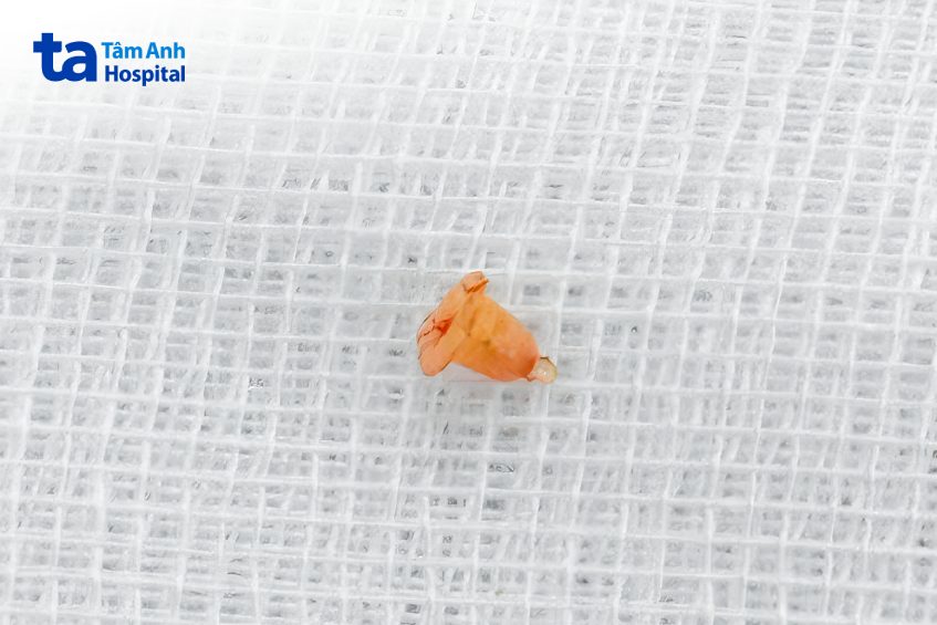 chuôi khuyên tai bị bỏ quên