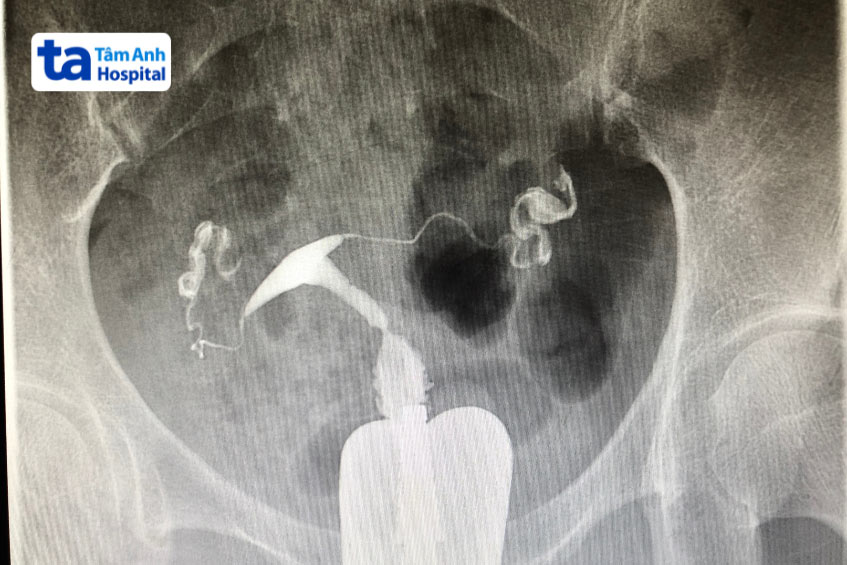 Chụp HSG trước khi làm IVF giúp phát hiện các bất thường tử cung, vòi trứng, hỗ trợ lên kế hoạch điều trị phù hợp