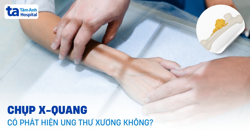 Chụp X-quang có phát hiện ung thư xương không? Quy trình thế nào?