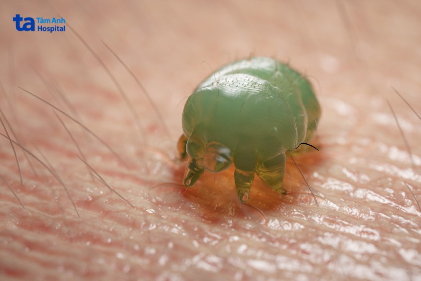 con cái ghẻ là nguyên nhân gây bệnh ghẻ ở vùng kín