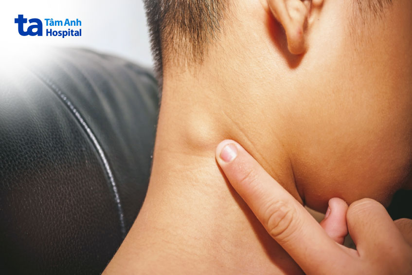 dấu hiệu hạch bạch huyết lành tính