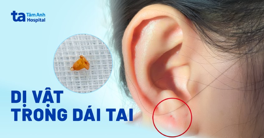 dị vật trong dái tai