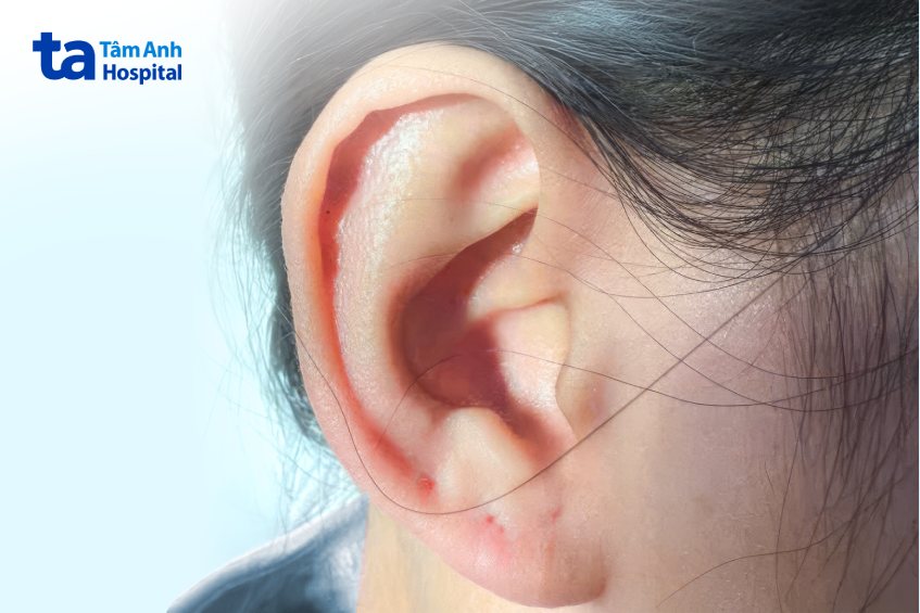 dị vật trong tai bị bỏ quên