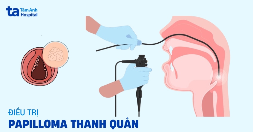 Phương pháp điều trị papilloma thanh quản như nào để hiệu quả?