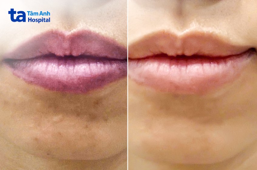điều trị thâm môi trước và sau