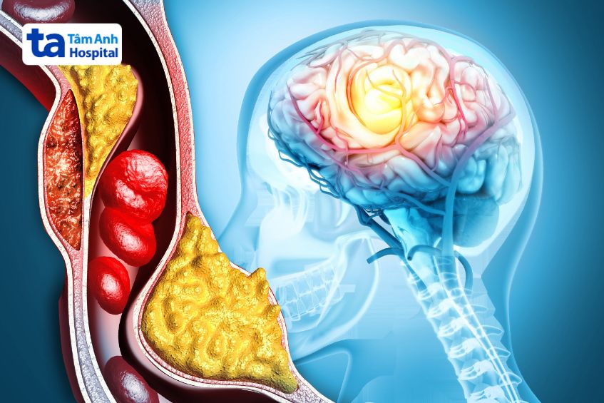 điều trị thiểu năng tuần hoàn não ảnh hưởng nhiều yếu tố