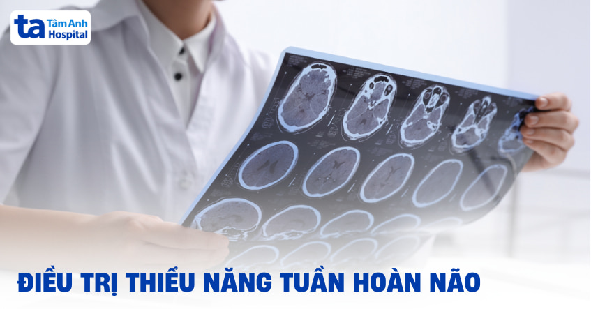 3 cách điều trị thiểu năng tuần hoàn não phổ biến, hiệu quả