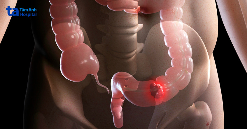 điều trị ung thư đại tràng có thể gây tác dụng phụ