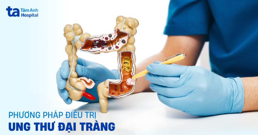 5 phương pháp điều trị ung thư đại tràng – Ưu và nhược điểm