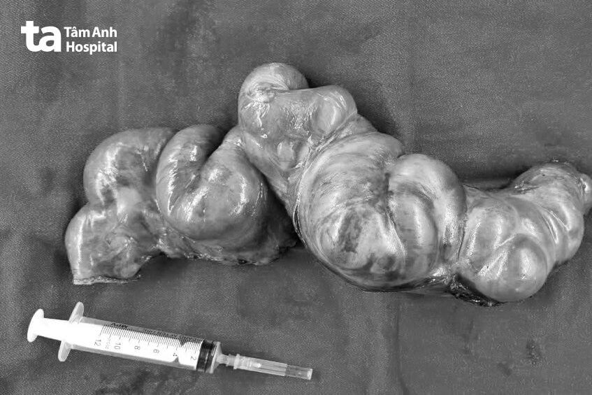 đoạn ruột bị cắt