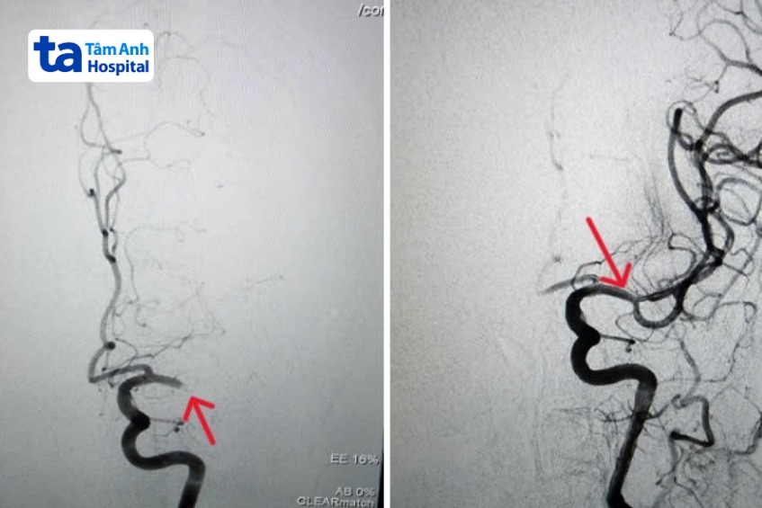 động mạch não giữa bên trái trước và sau tái thông