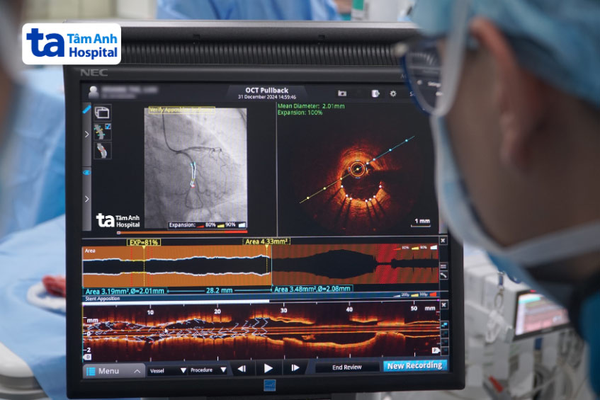 Ê kíp sử dụng kỹ thuật chụp cắt lớp kết quang nội mạch để đặt stent