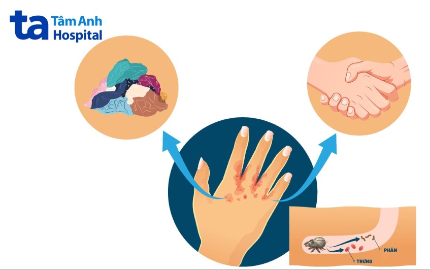 ghẻ có di truyền không