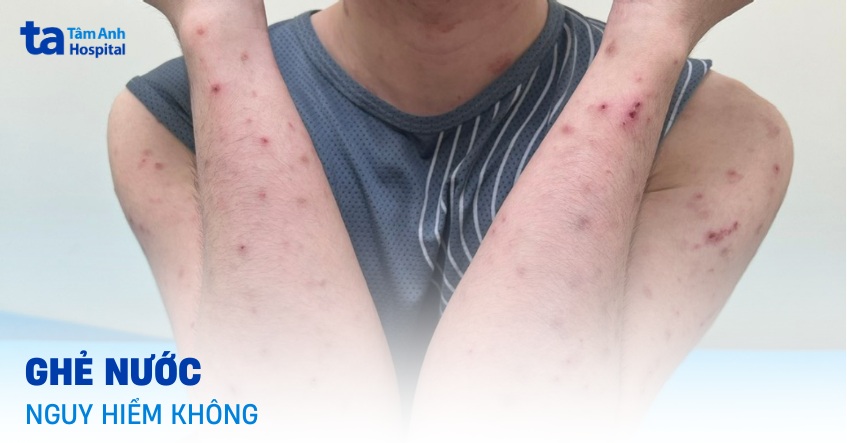 Ghẻ nước có nguy hiểm không? Biến chứng tiềm ẩn bạn cần biết