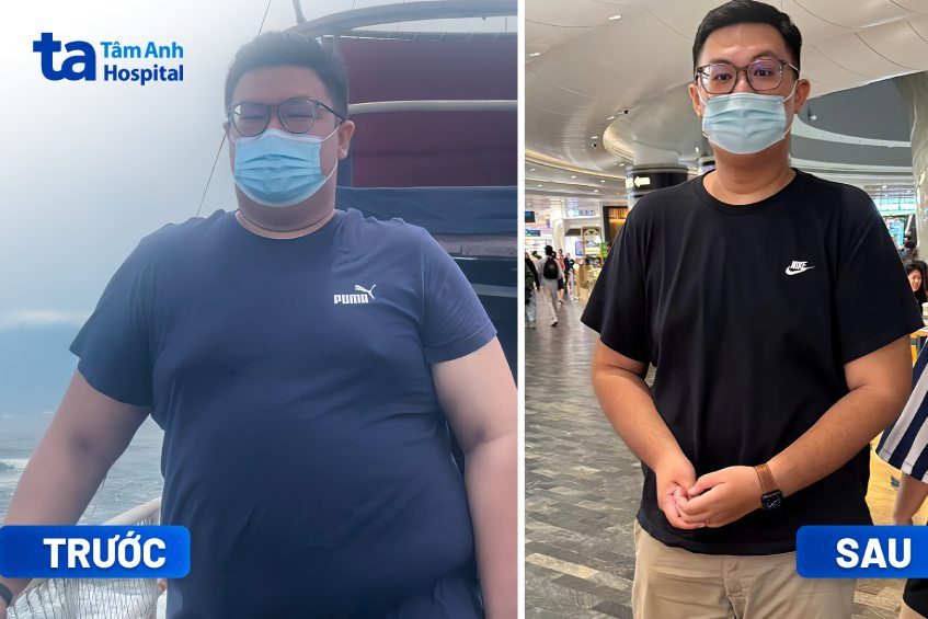 giảm cân sau ca phẫu thuật