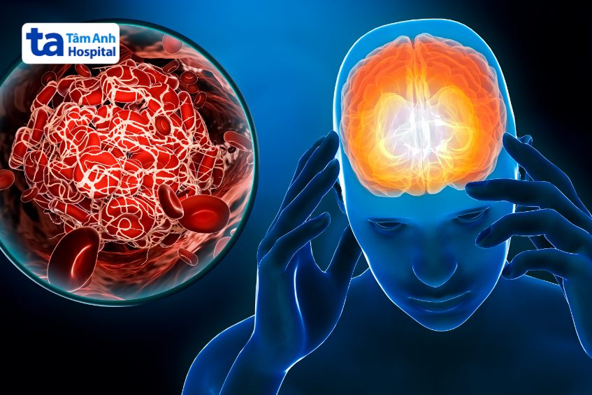 giảm lưu lượng máu đến não do thiểu năng tuần hoàn não