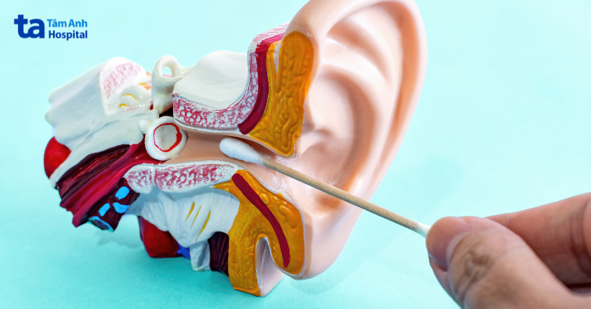 Các dạng suy giảm thính lực