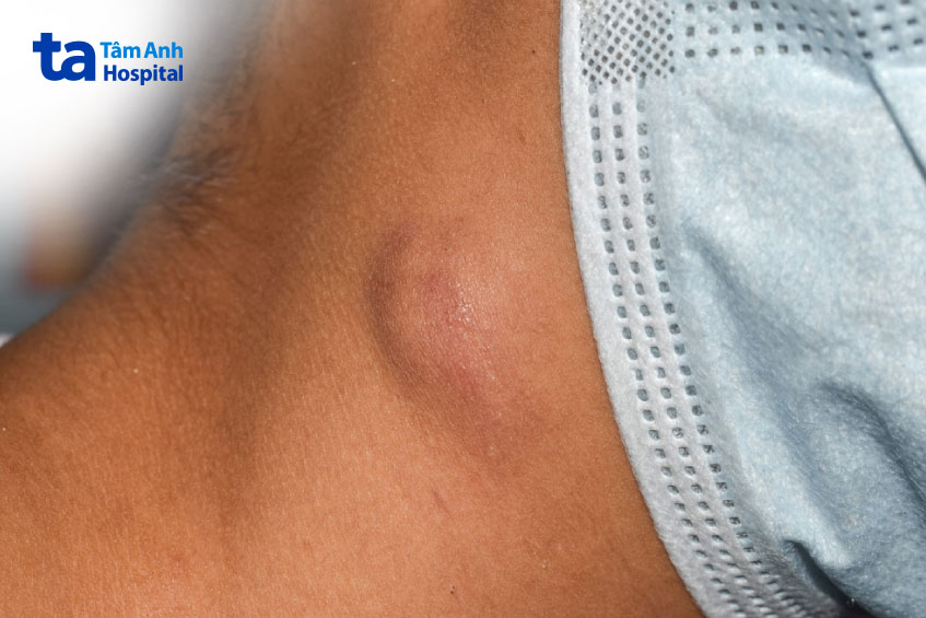 hạch nổi ở vùng cổ