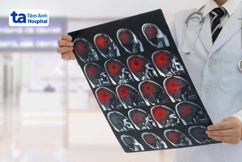 hay bị đau đầu vùng trán dữ dội có thể là dấu hiệu của u não