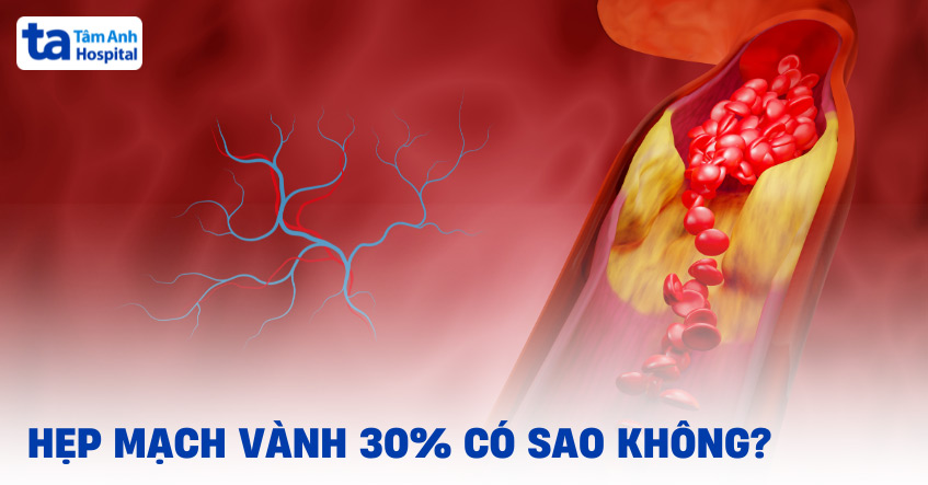 Hẹp mạch vành 30% có sao không? Đã đánh giá nguy hiểm chưa?