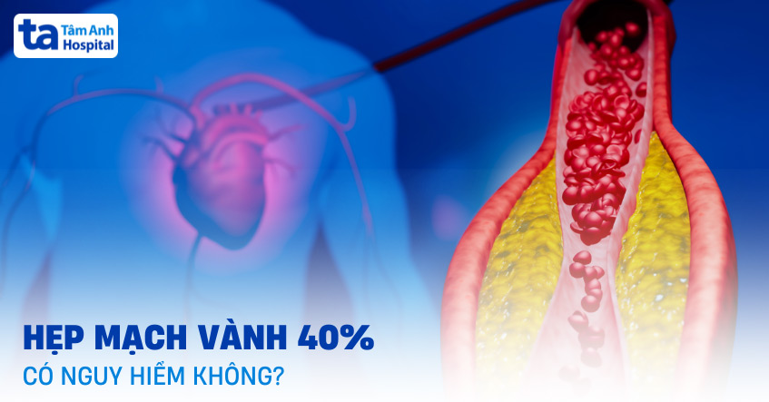 Hẹp mạch vành 40% có nguy hiểm không? Mức độ nghiêm trọng ra sao?