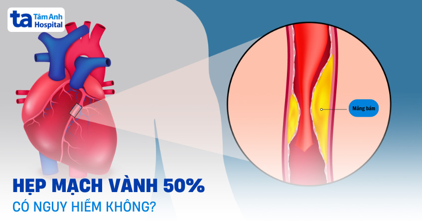 Hẹp mạch vành 50% có nguy hiểm không? Khi nào cần can thiệp?
