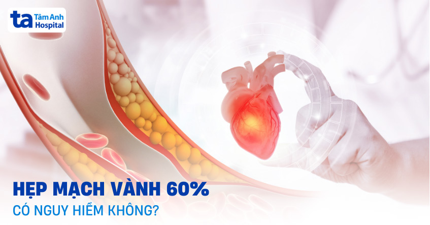 Hẹp mạch vành 60% có nguy hiểm không? Chỉ định can thiệp khi nào?