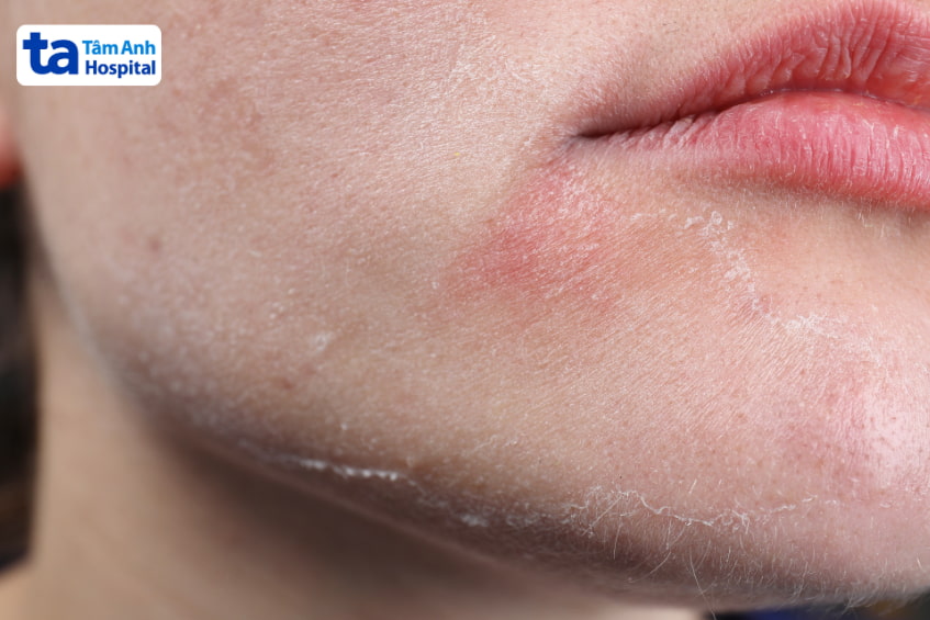 Tác dụng phụ của Retinol