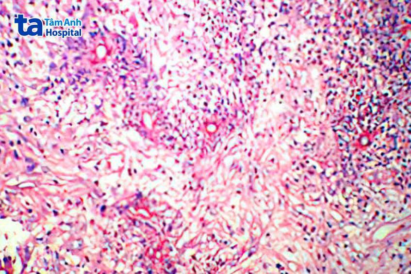 hình ảnh ấu trùng