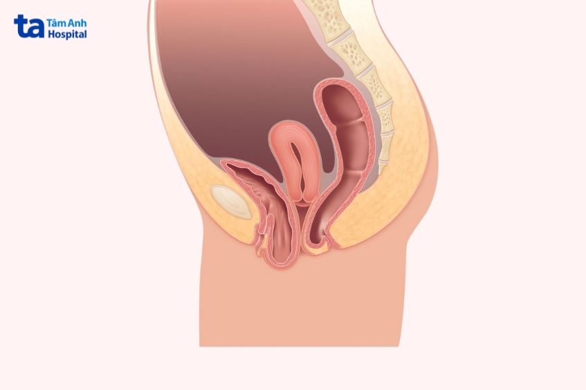 hình ảnh bàng quang sa xuống âm đạo