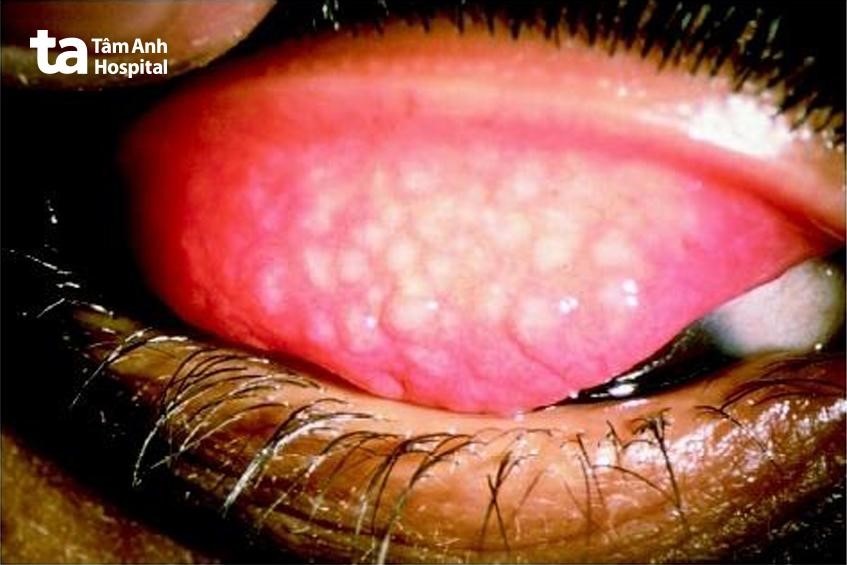 hình ảnh bệnh gây nổi hột ở mắt