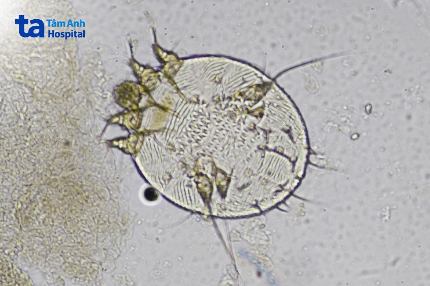 hình ảnh con cái ghẻ dưới kính hiển vi