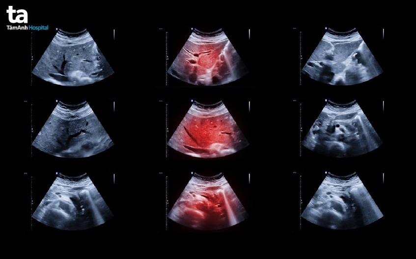 hình ảnh khám gan