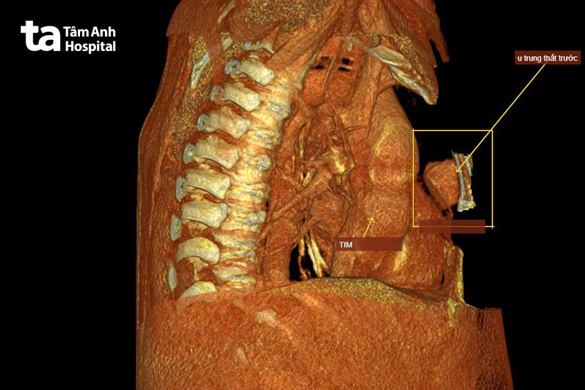 Hình ảnh khối u trung thất trên phim chụp CT