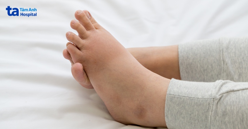 hội chứng thận hư được biểu hiện với các triệu chứng phù nề