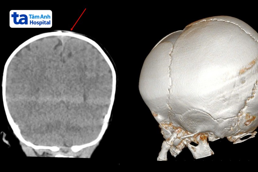 kết quả chụp ct não của bé cường