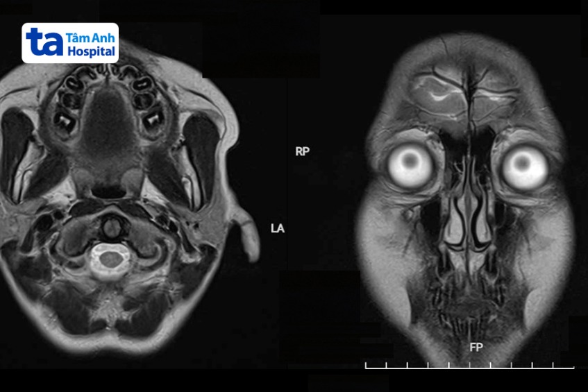 kết quả mri cho thấy bé chi không phát hiện khối u