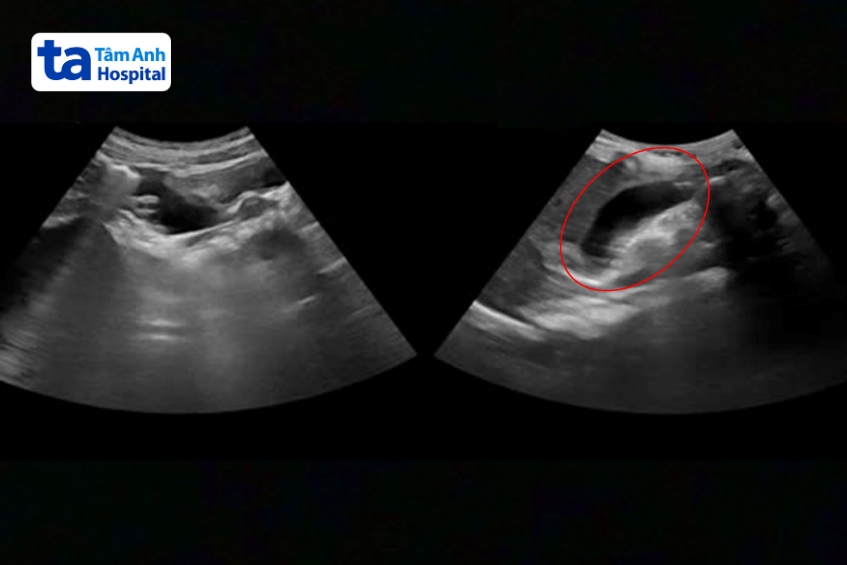 kết quả siêu âm cho thấy viêm ruột thừa kèm sỏi phân