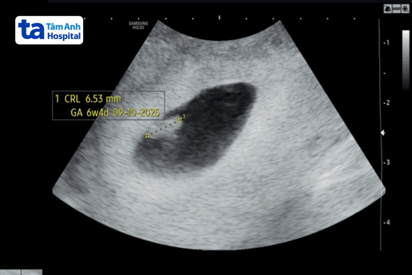 kết quả siêu âm tim thai của chị hằng