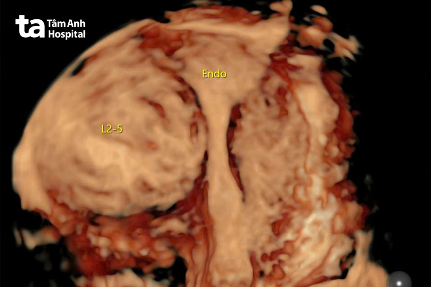 khối u xơ chiếm toàn bộ tử cung