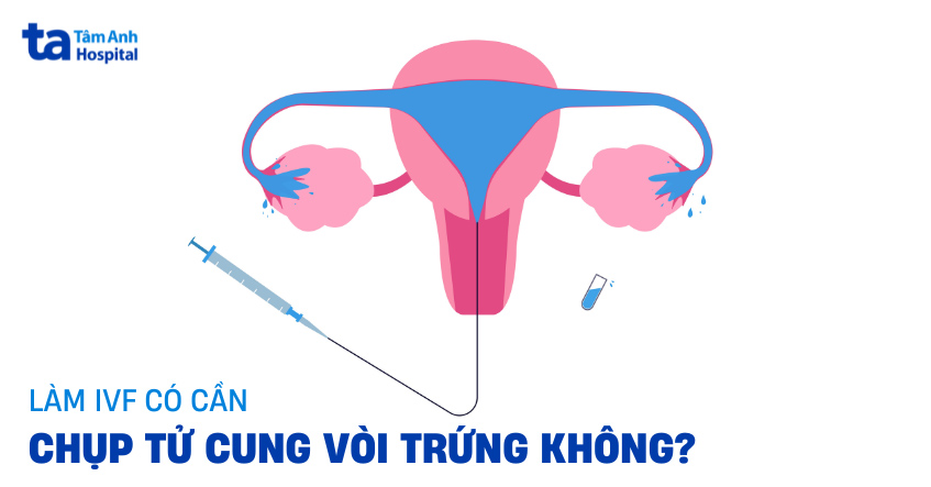 Làm IVF có cần chụp tử cung vòi trứng không? Chụp trước bao lâu?